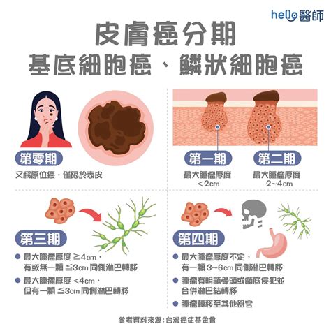 手臂長痣|皮膚長痣、長斑是皮膚癌前兆？皮膚癌初期4大症狀快。